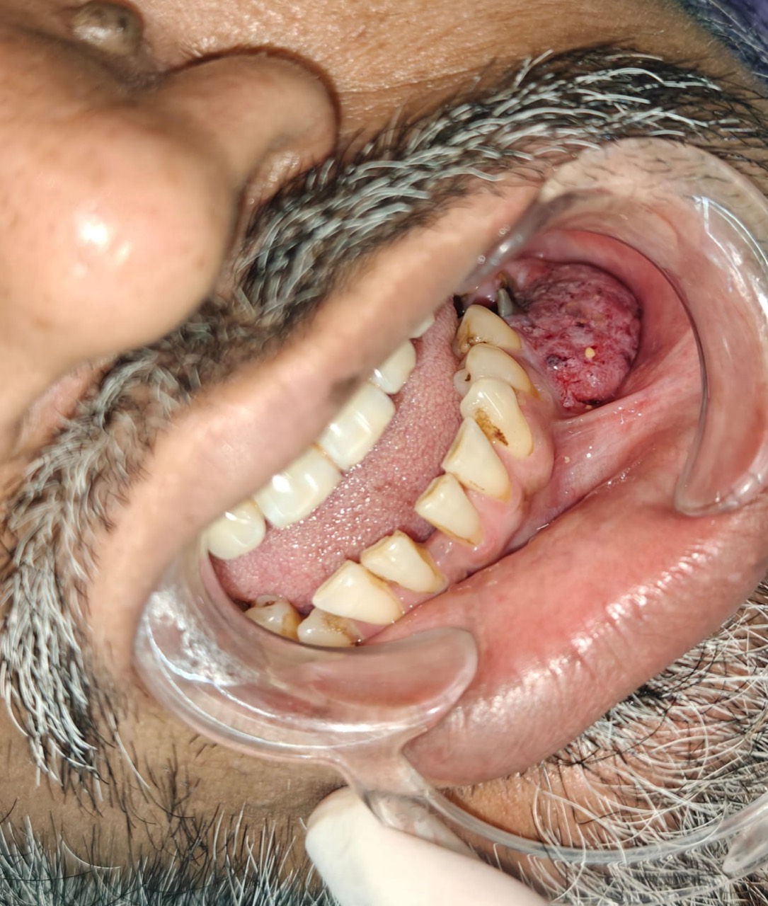 Oral tumour assessment