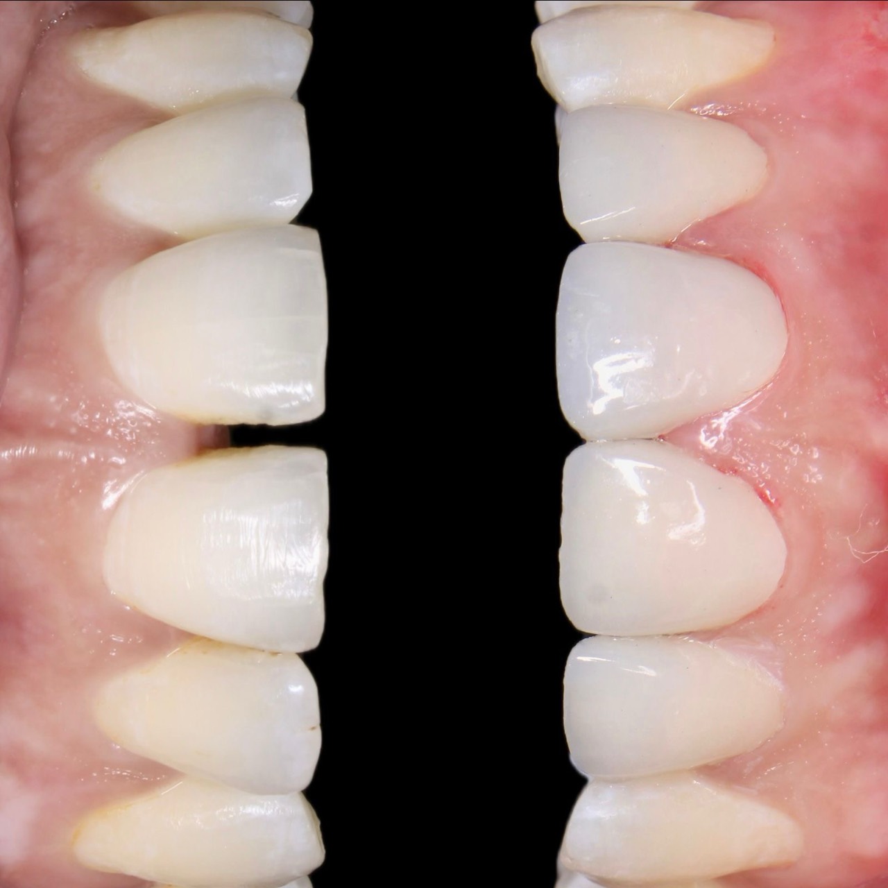 Smile designing and veneers