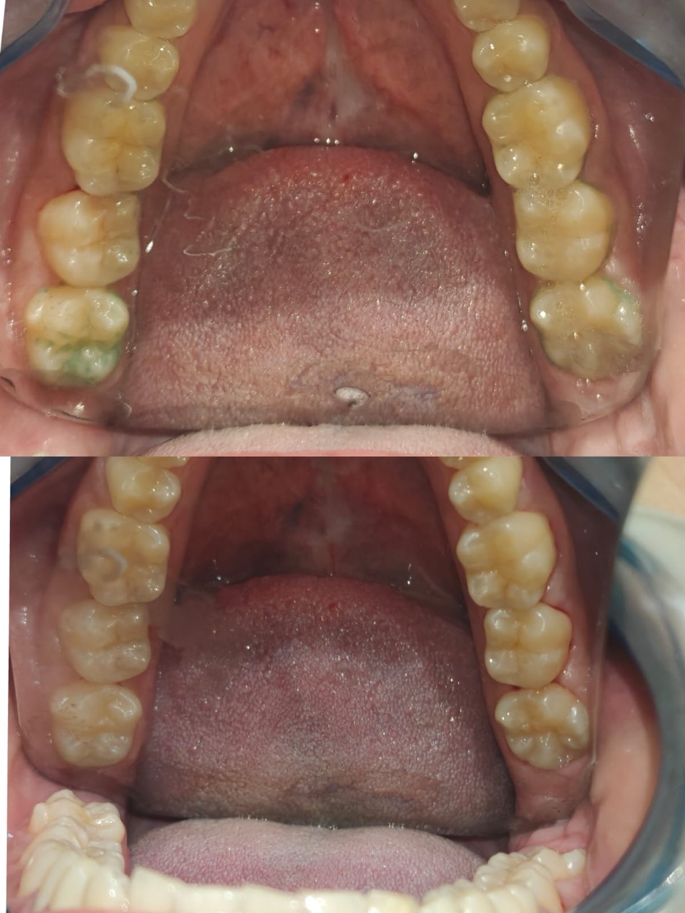 Green-stain removal and periodontal care