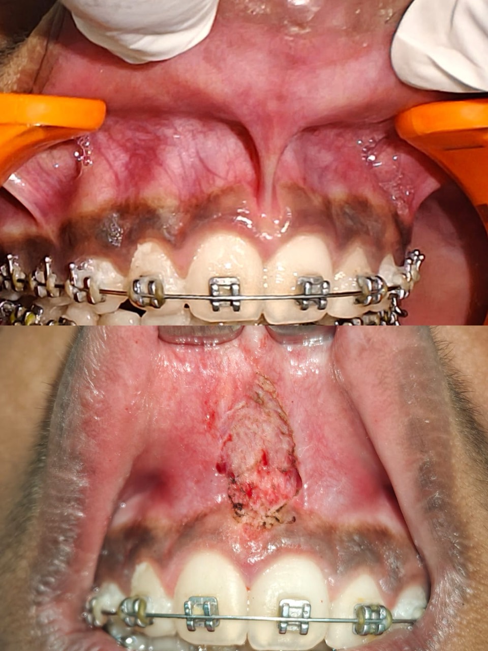 Laser frenectomy