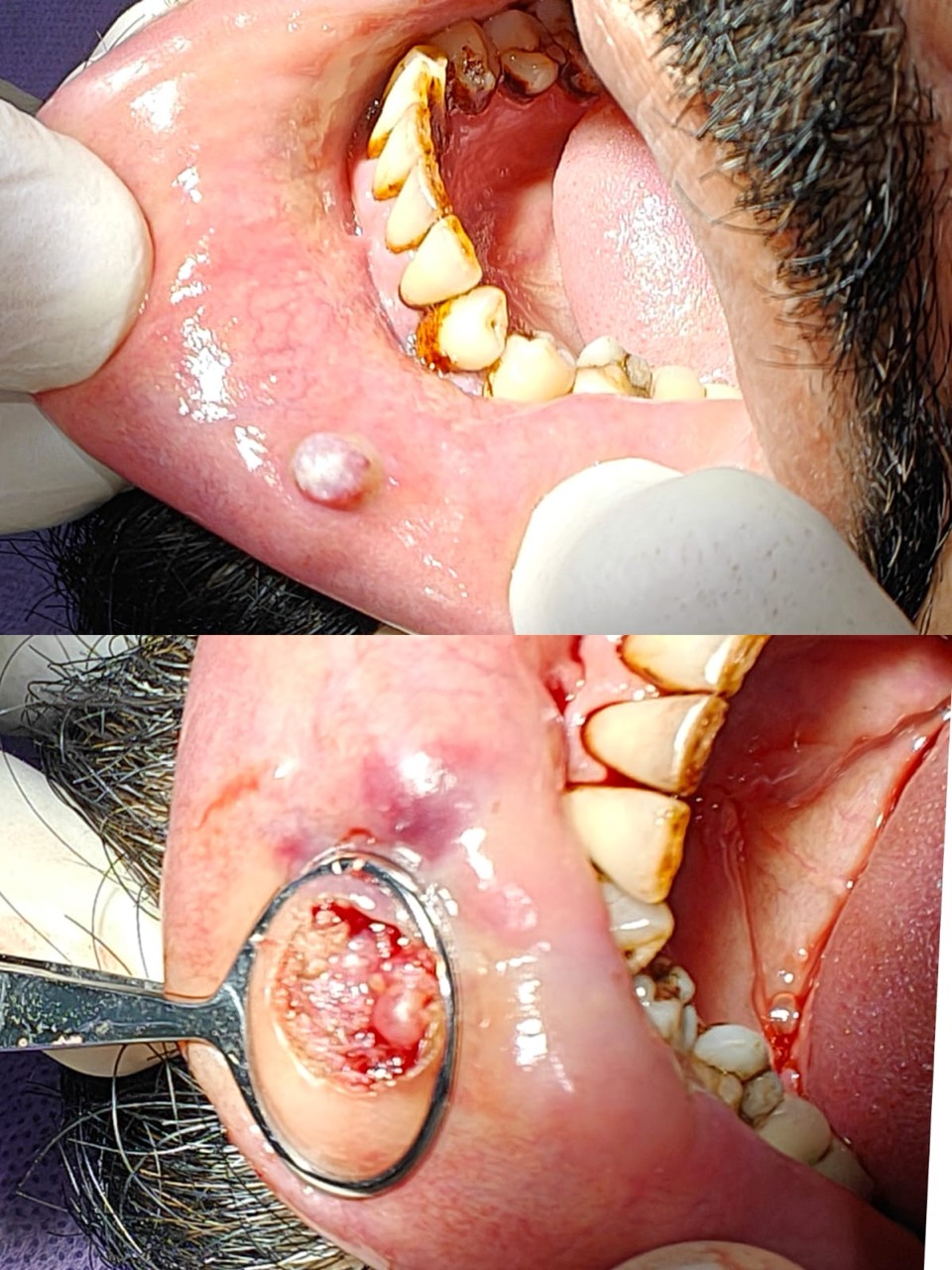 Mucocele management