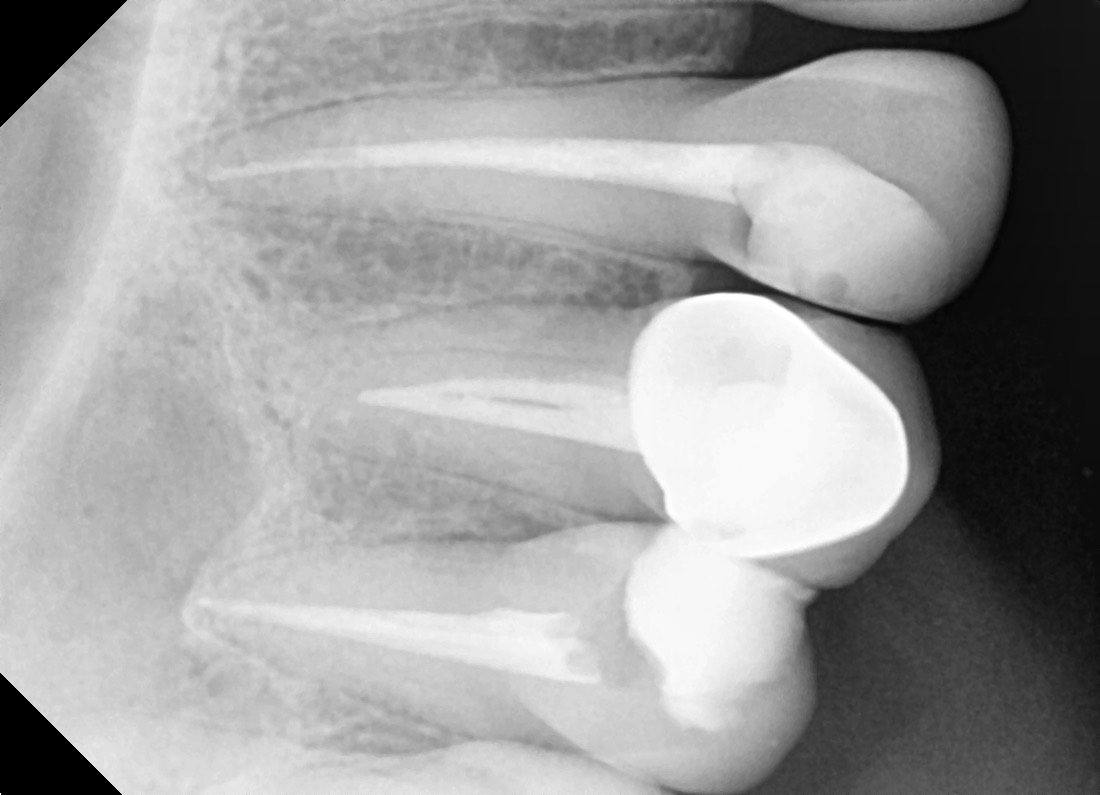 Root canal treatment